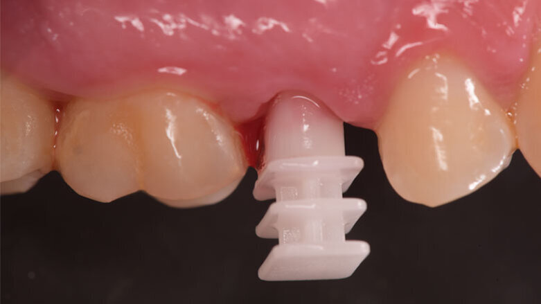 Impianto post-estrattivo a carico immediato in Zirconia