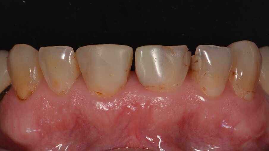 Vooraanzicht van het bovenfront: veel oude vullingen zijn aan vervanging toe door slechte randaanpassing en/of verkeerde kleuren.
