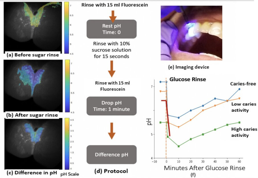 Case study employing multi-modal scanning fibre endoscope (mm-SFE) for pH sensing. The subject had not received professional cleaning for over seven months and had skipped brushing for five days prior to the examination. (a) Interproximal dental biofilm image with pH heat map. (b) The pH heat map after sugar rinse. (c) The difference between rest pH and drop pH. (d) The protocol used for testing with mm-SFE. Fluorescein is rinsed instead of applied on each tooth surface using a blunt hypodermic needle. (e) The mm-SFE pH probe. (f) The Stephan curve, red line indicating average pH obtained using images at each stage of rest pH and drop pH. (Image: University of Washington)