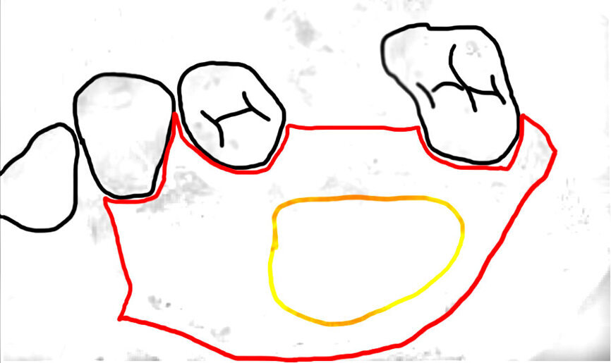 Ryc. 2 a_Wytworzenie okna kostnego od strony podniebiennej, uwidaczniając nienaruszoną membranę Schneidera.