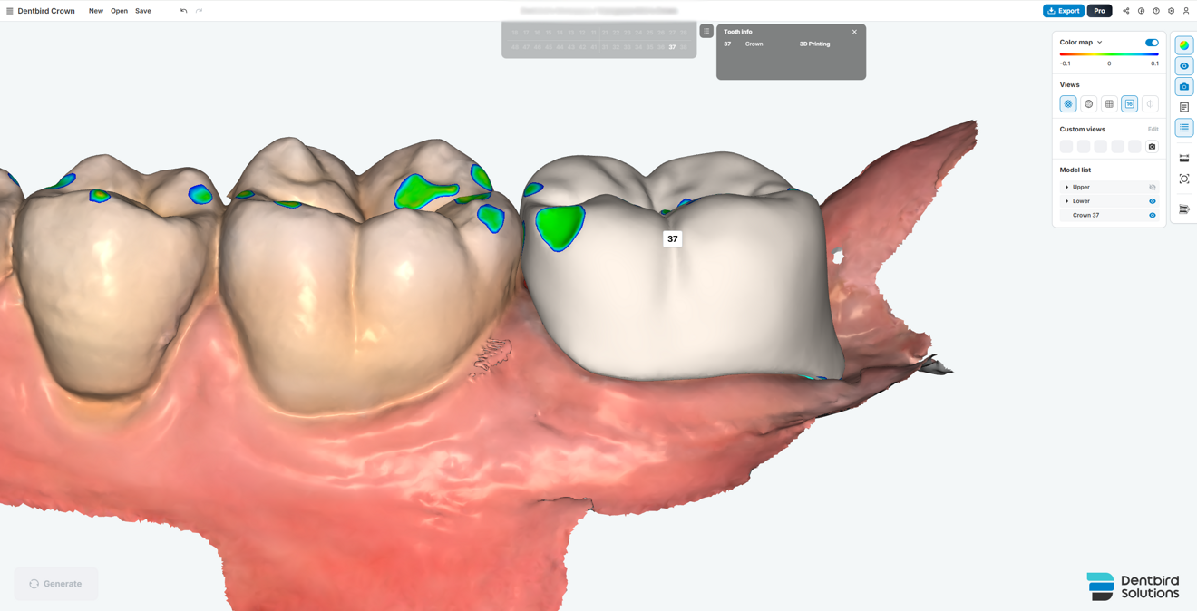 Fig. 4b: Assessment of proximal contact with the adjacent tooth. 