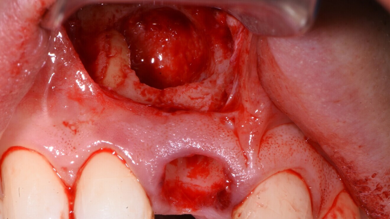 Fig. 5: Extraction socket with the infra-bony cyst cavity exposed.