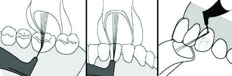 Fig. 7: The optimal positioning of the suction tube
