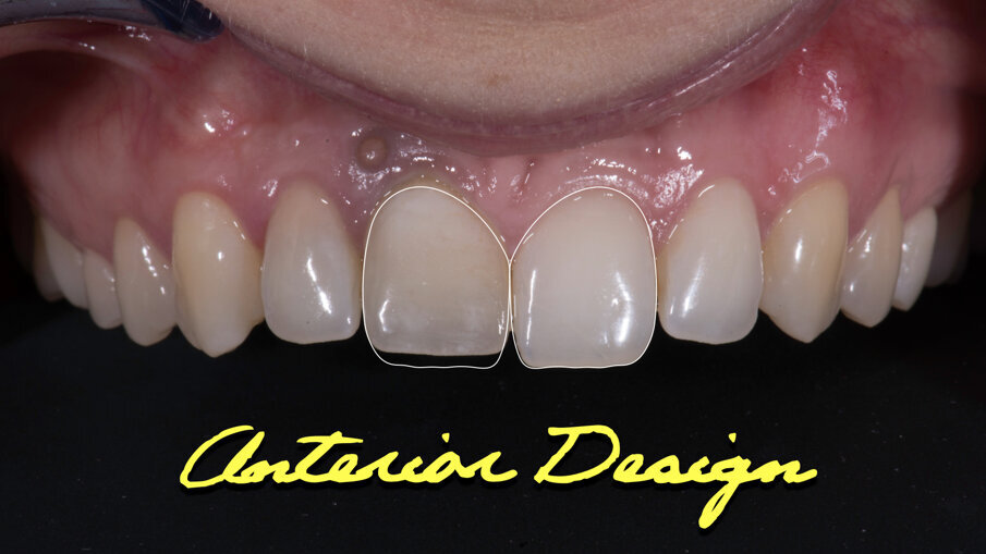 Fig. 7_Disegno dei denti frontali.