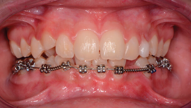 Il tailor-made del controllo del biofilm batterico. Nel paziente in trattamento ortodontico: case report