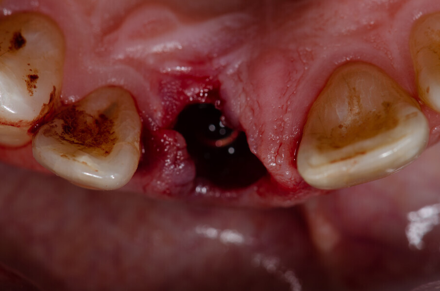 Fig. 15b: Situation after implant placement, occlusal view.