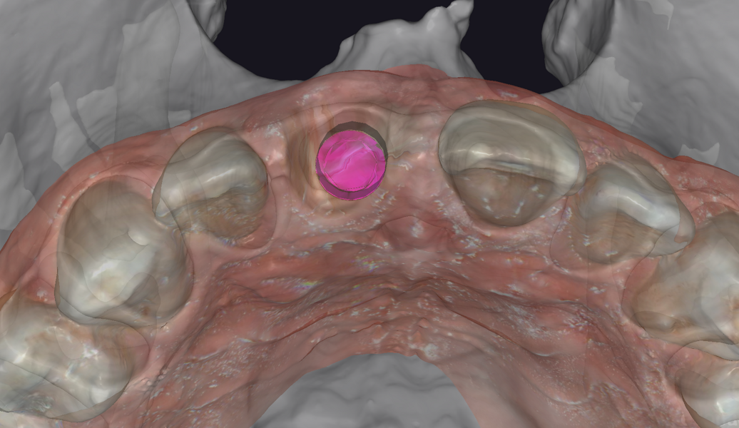 Fig. 8c: Virtual implant placement in exoplan in region #11, showing the location relative to the adjacent crowns and roots, occlusal view.