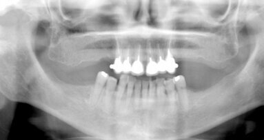 El tratamiento con ozono de la osteonecrosis asociada a bifosfonatos
