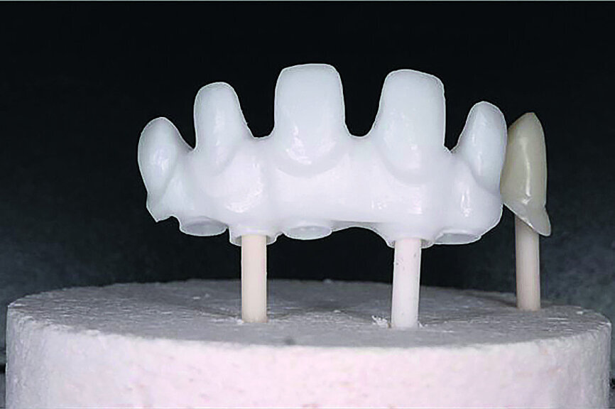 Fig. 32: Final prosthesis framework and the coping for the right canine tested on the working model.