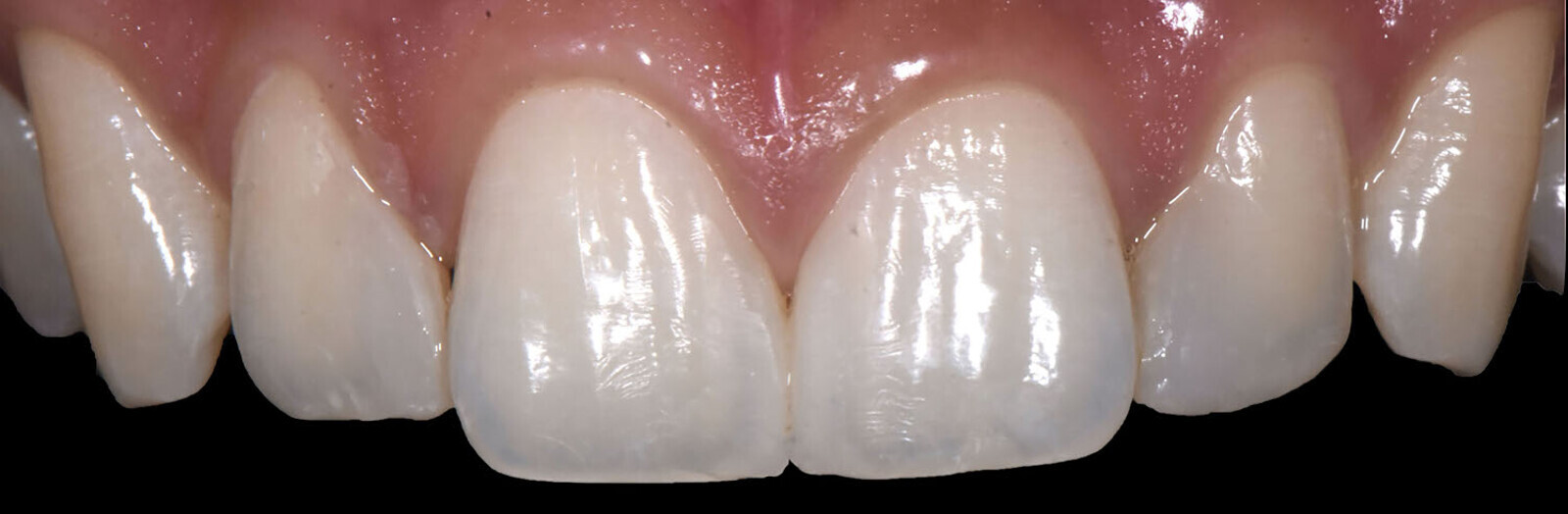 Fig. 21a: Six-month follow-up.