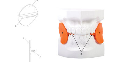 L’abitudine muscolare  come elemento di recidiva: il cross-bite