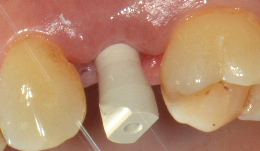 Fig. 13_Il corpo di scansione serrato nella seconda fase protesica.