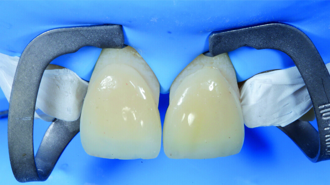 Fig. 17: Insertion of the veneers.