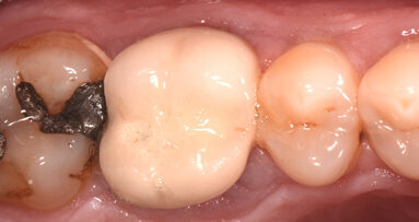 Restauración de una pieza tratada con endodoncia