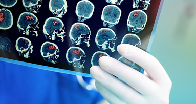 Schlechte Zahngesundheit birgt Risiko für Schlaganfälle