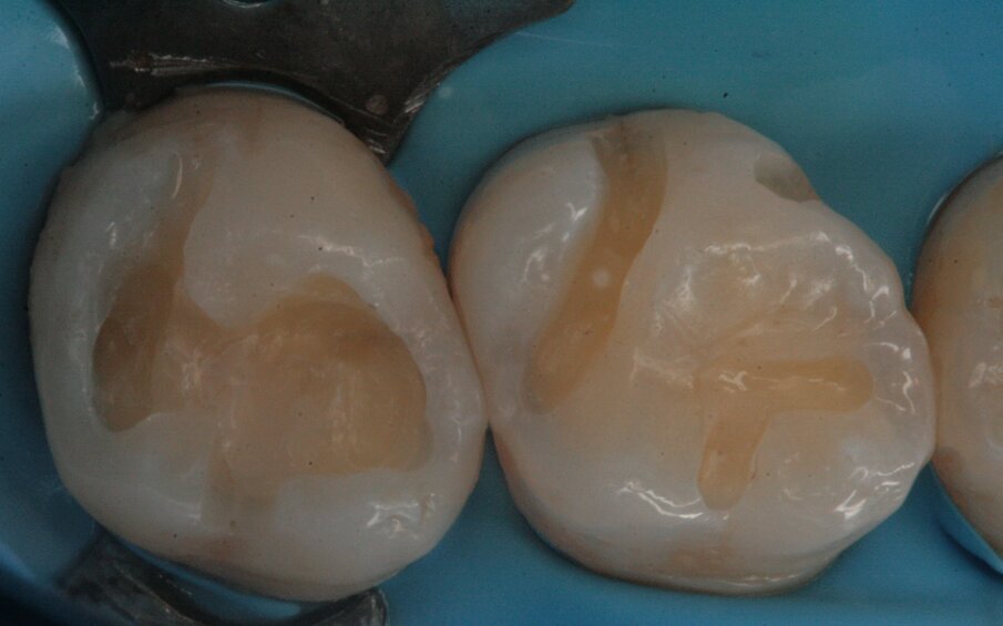 Figg. 15, 16_Preparazione delle cavità.