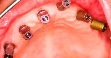 Nuova nanotecnologia per migliorare il ripristino osseo in pazienti dentali