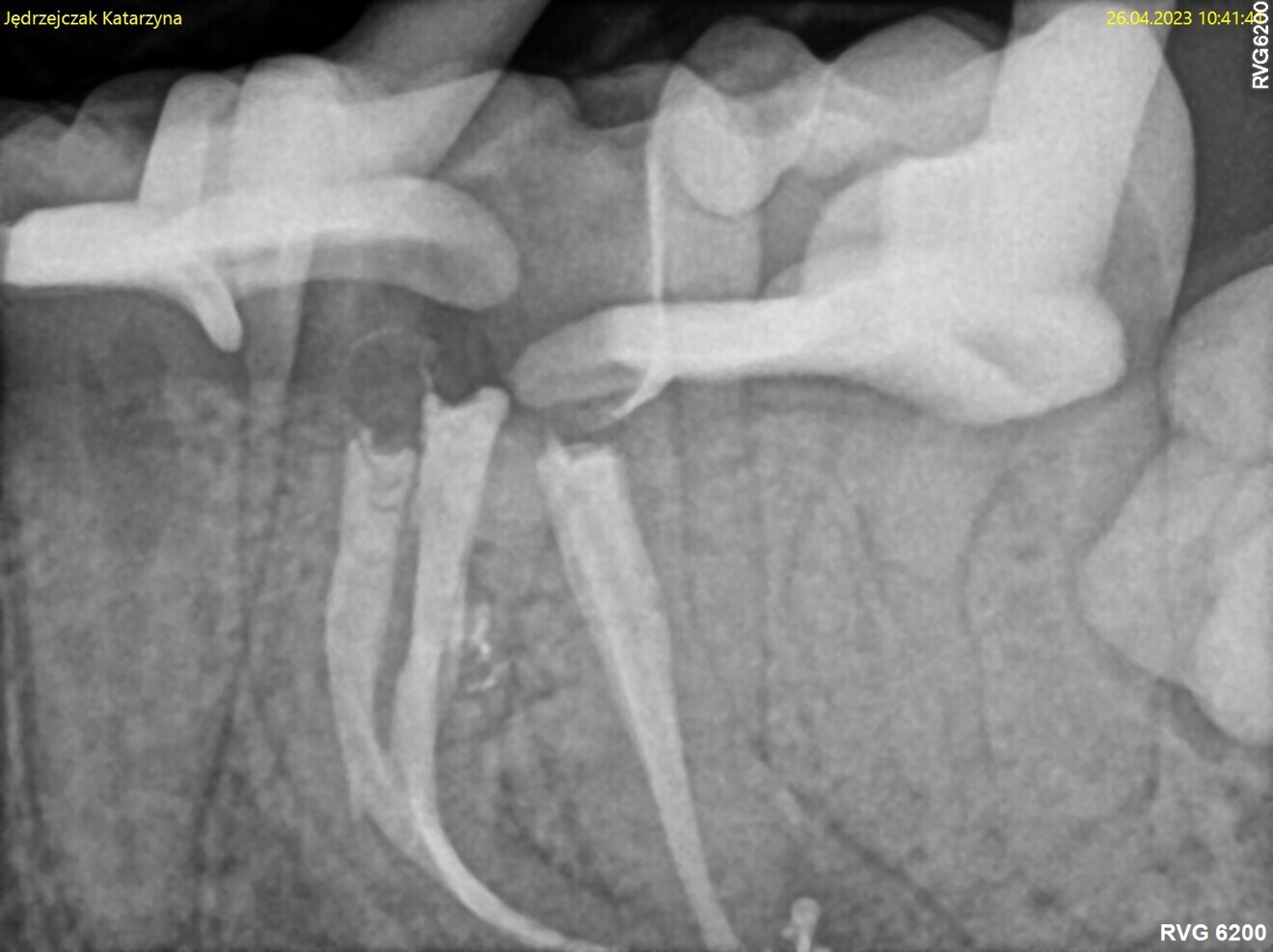 Fig. 11: Mesially shifted post-op radiograph.
