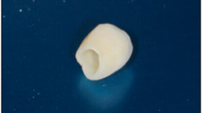 Implantes postextracción. ¿Una alternativa a la preservación alveolar?  Revisión de la literatura