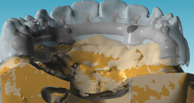 Gestione di un caso Full Arch con flusso digitale