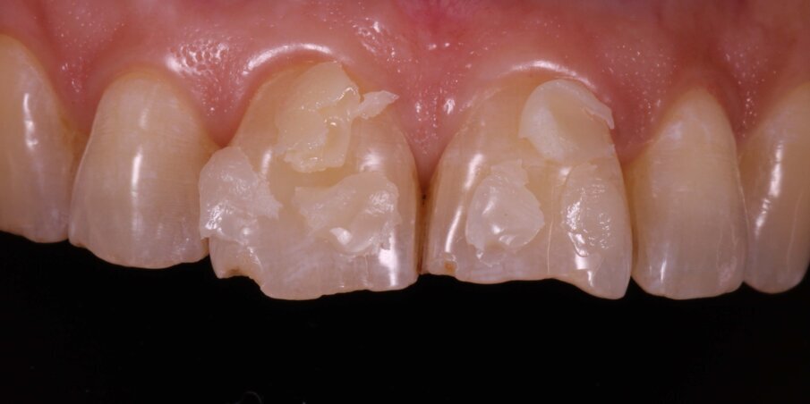 Fig 6: Shade matching
