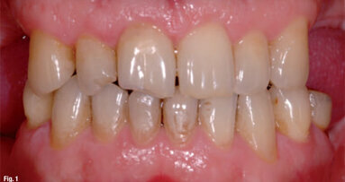 Fixed prosthodontic management of a mutilated dentition: A team approach