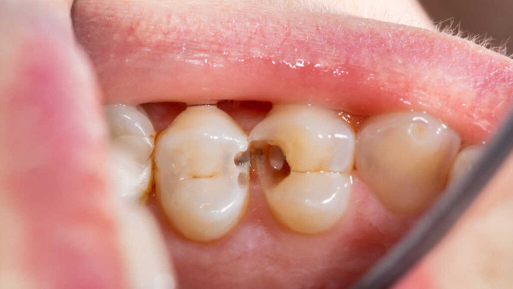 O estudo oferece novas visões sobre a doença periodontal e a resposta protetora do corpo