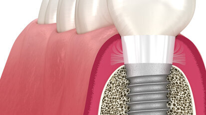 Livre blanc : comment favoriser une adhésion tissulaire naturelle en implantologie ?