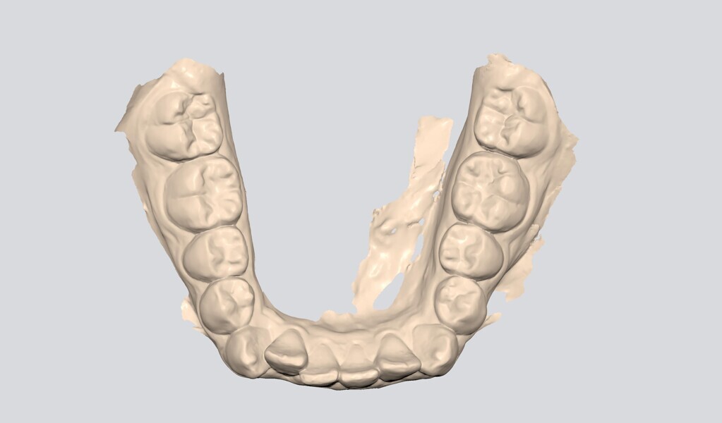 Figs. 6–10: The corresponding digital STL files of the initial condition.