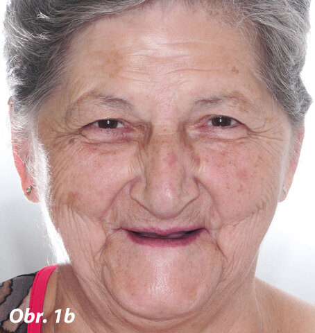 Pacientka požadující okamžité a finančně dostupné ošetření bezzubé horní a dolní čelisti