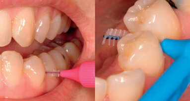 La pulizia interdentale su basi scientifiche