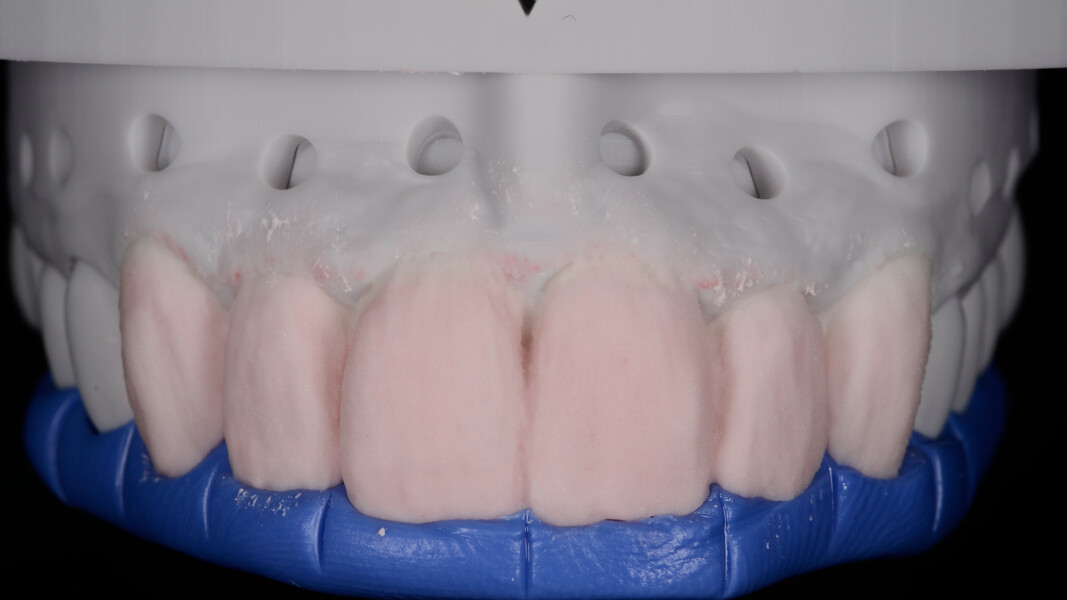 Fig. 15: Application of CERABIEN ZR Body in Shade NW0.5B to restore the crown contours using a silicone index.