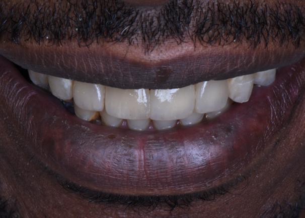 Step 8 – Post operative view  Highly aesthetic outcome using  (ceram.x® duo).   