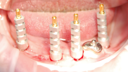 Cyfrowe narzędzia na różnych etapach leczenia implatoprotetycznego bezzębnej żuchwy