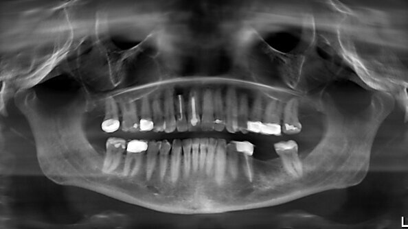 Un concept prothétique implanto-porté d’avant-garde pour une réussite et une stabilité tissulaire à long terme