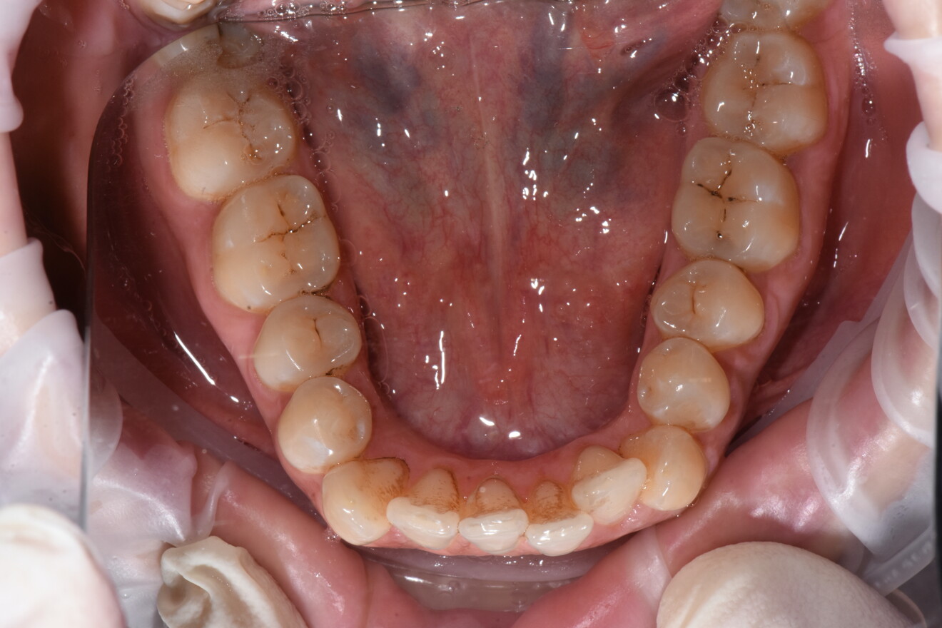 Figg. 1-3 - Situazione iniziale arcata superiore e inferiore, foto intraorali.
