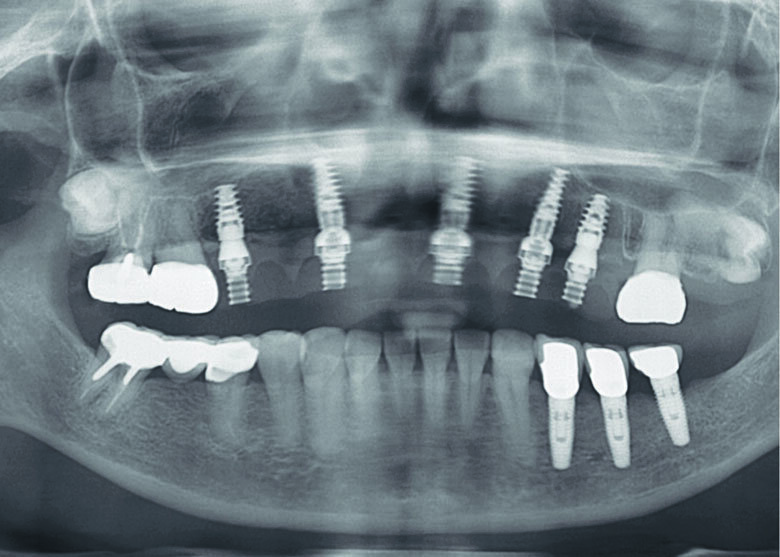 Fig 22. Post-operative panoramic XRAY