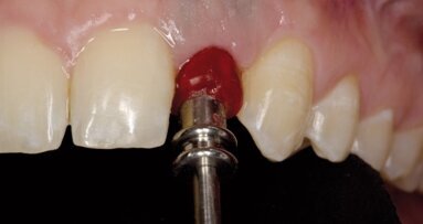 Zastosowanie techniki CAD/CAM do zindywidualizowania łącznika standardowego