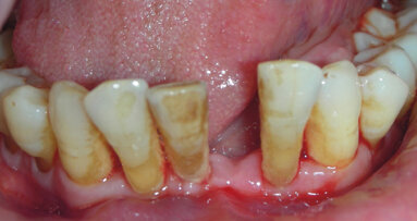 L’odontoiatria a misura  del paziente con patologia osteometabolica a rischio di osteonecrosi delle ossa mascellari da farmaci