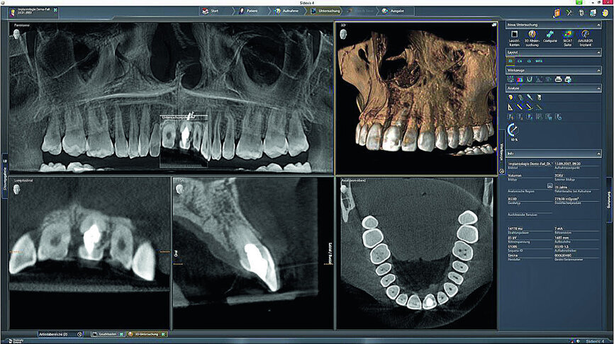 Fig. 3: The initial situation in 3-D in the Sidexis 4
imaging software (Dentsply Sirona) showed good apical bone substance with the possibility of immediate implantation.