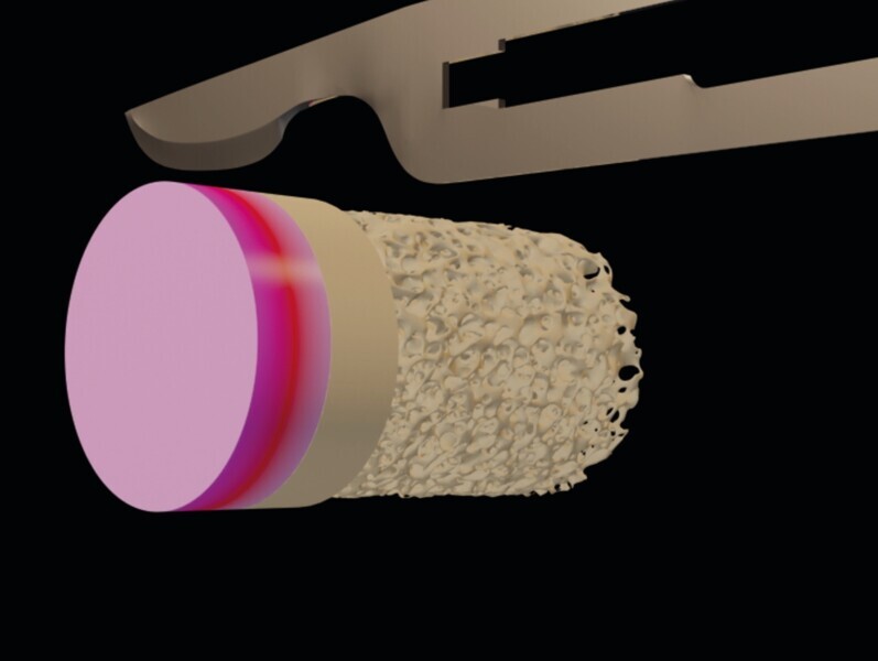 Fig. 24 : Les quatres parties de la carotte tubérositaire. Os spongieux, os cortical, gencive et gencive kératinisée. 