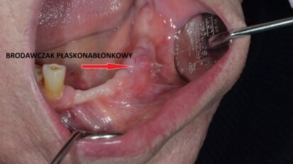 Czujność onkologiczna w leczeniu implantoprotetycznym – wirus brodawczaka ludzkiego HPV