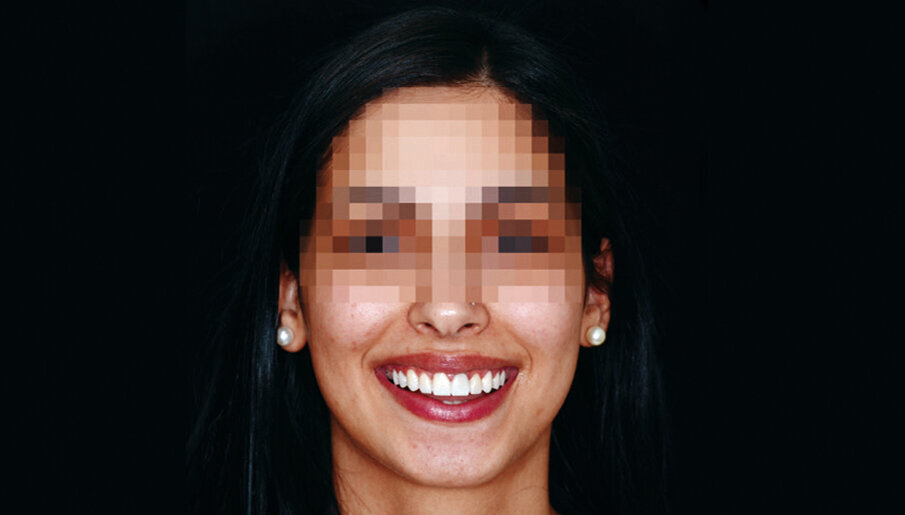 Slika 7. Novi privremeni nadomjestak nakon cijeljenja