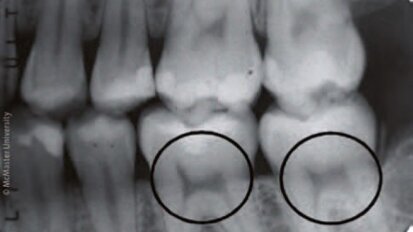 Zobni rentgen lahko razkrije pomanjkanje vitamina D