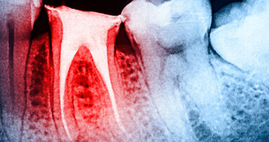 Los beneficios de los instrumentos rotatorios NiTi con movimiénto recíproco