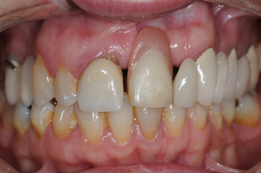 Fig. 1 - Situazione iniziale della paziente al momento della prima visita.