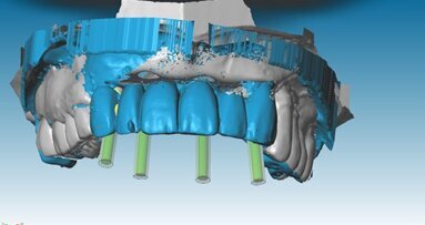 Immediate Smile strategy dans les secteurs esthétiques - Optimisation des technologies numériques au cabinet et au laboratoire au service de la mise en charge instantanée