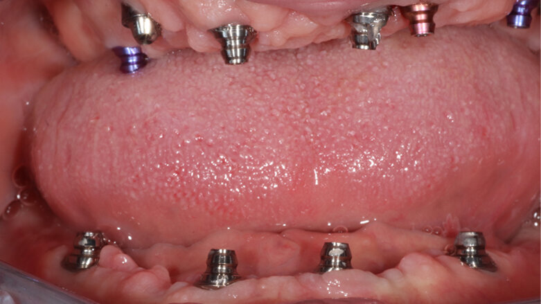 Riabilitazione di arcata mascellare edentula a carico immediato