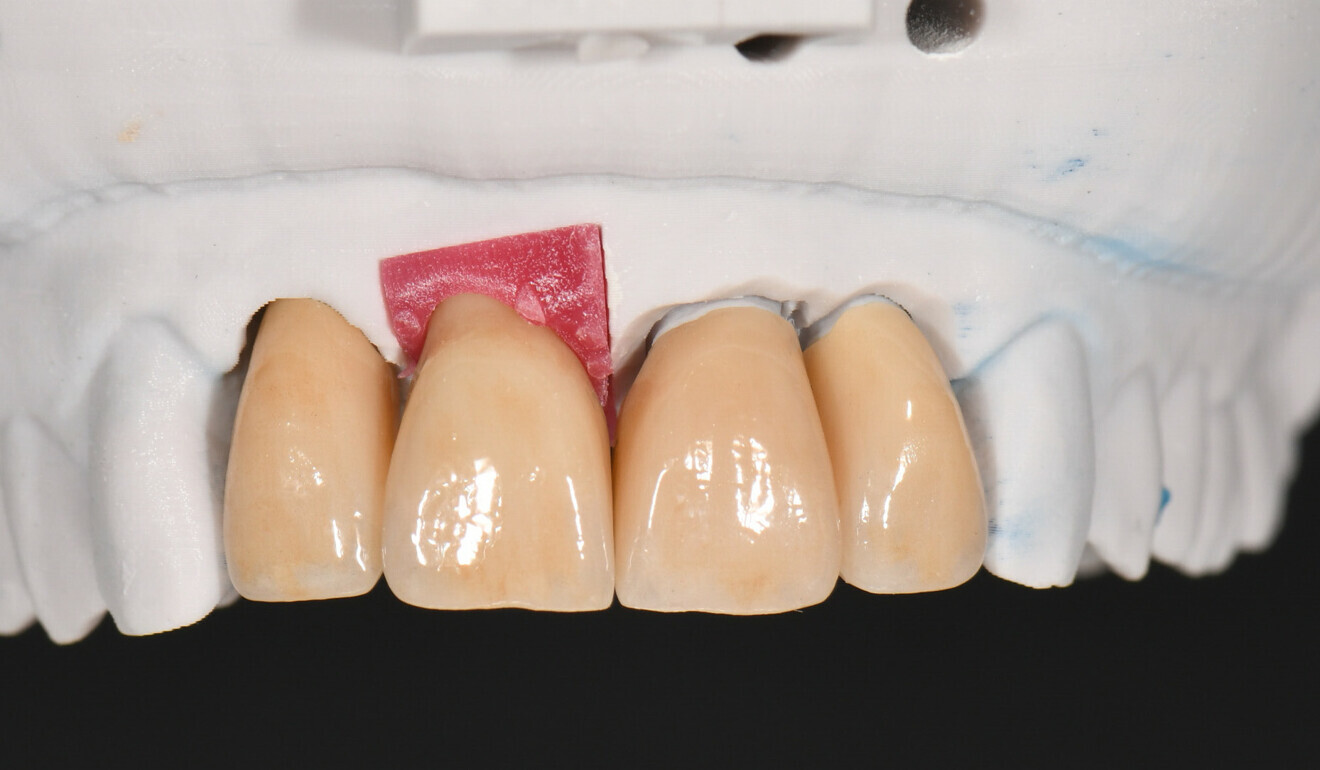 Fig. 11: Final restorations on the model.