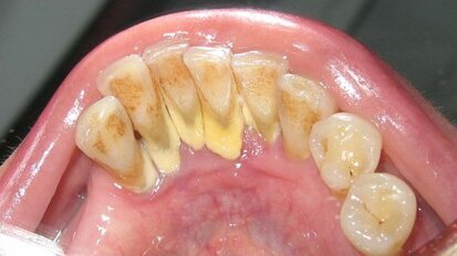 Kamień nazębny – problem poważny i wciąż ignorowany